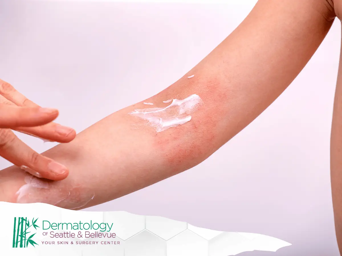 Applying cream to eczema flare-up on arm to demonstrate treatment effectiveness.
