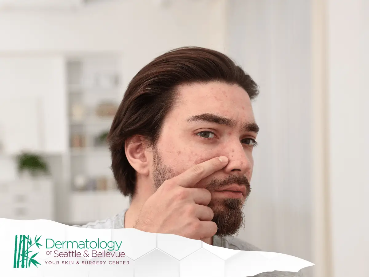 Man with facial acne touching his nose in a bright room