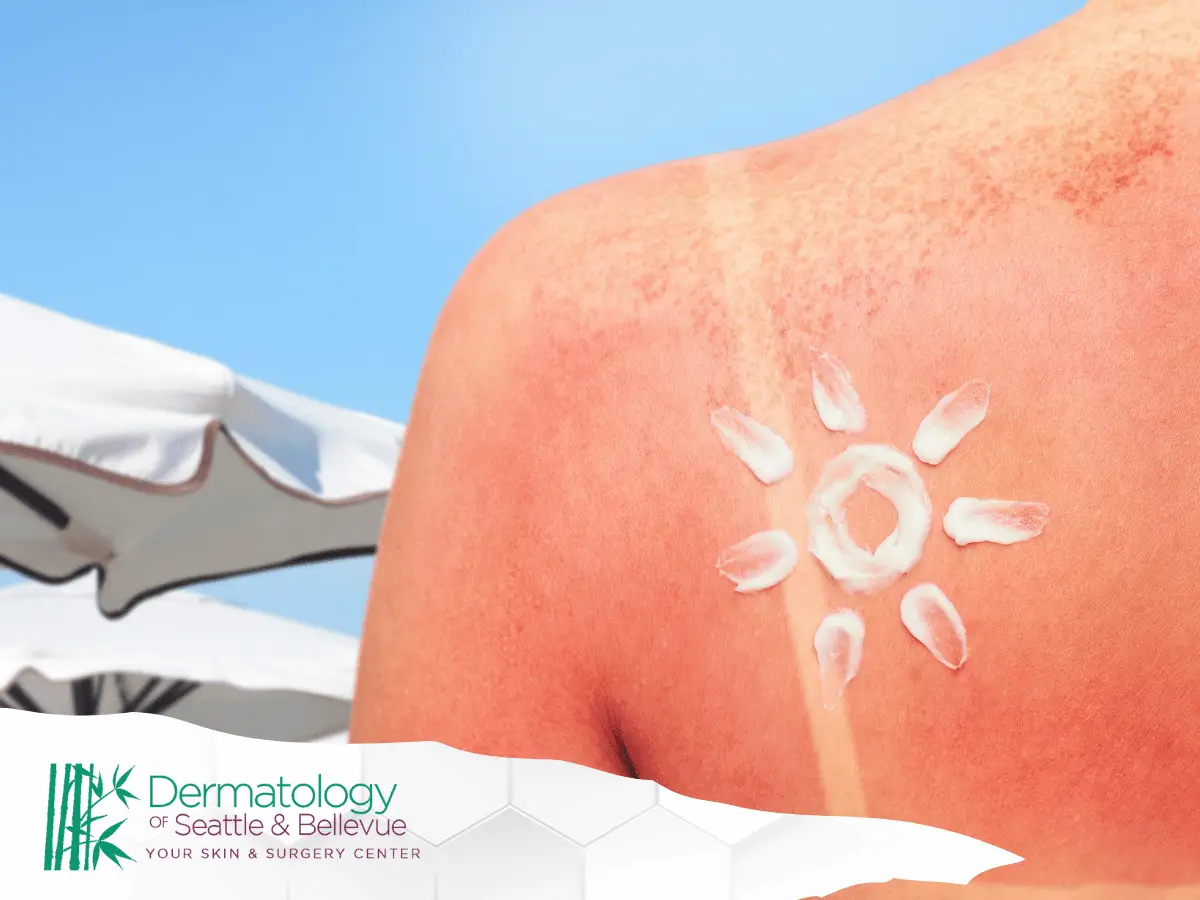 Sunburned back with sunscreen drawn as a white sun.