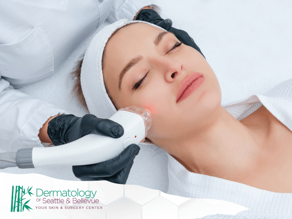 Woman receiving laser treatment on her cheek in a spa setting.