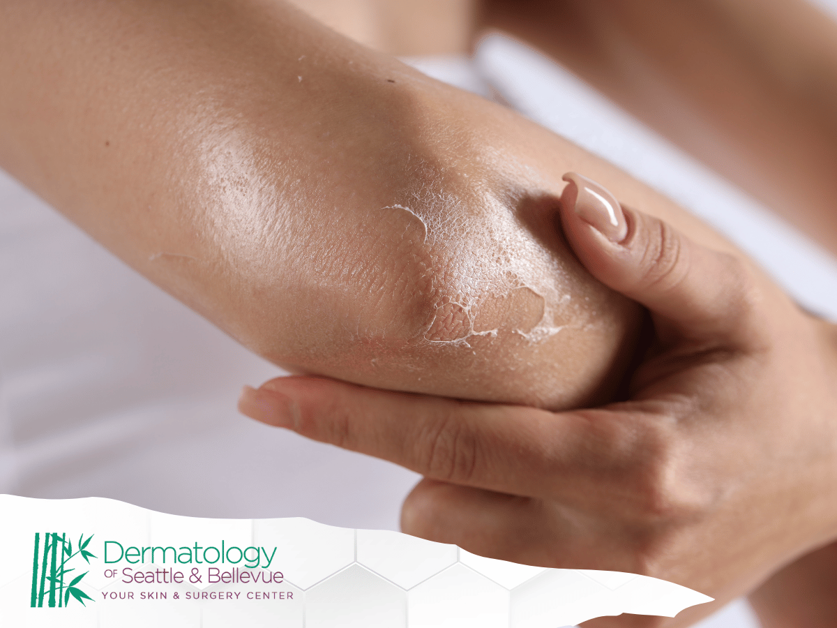 Woman applying moisturizer to dry elbow skin.