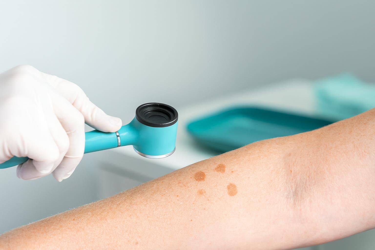A gloved hand holding a teal dermatoscope over a skin arm with brown spots.