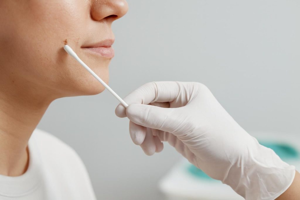 Woman applying a cotton swab to a dark spot on her chin.